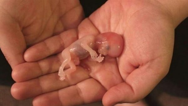 İlk ayda fetüsün şekli düşüyorsa 10. İlk ayda kürtaj sonrası yapılması gereken tıbbi işlemler.
